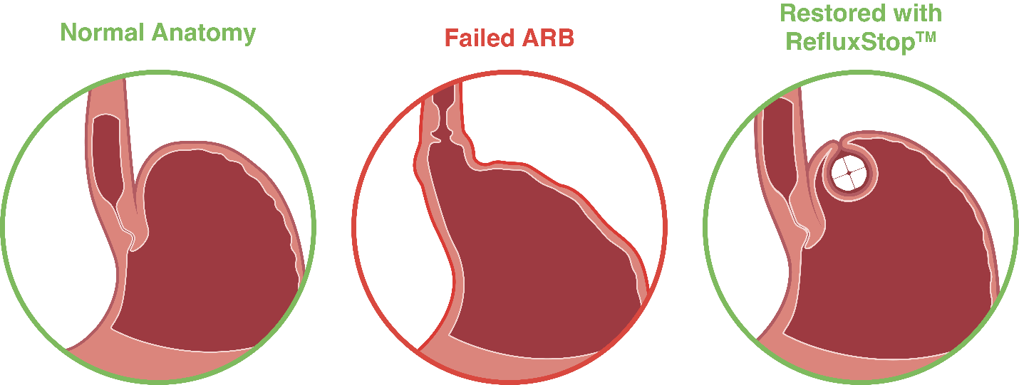 RefluxStop restoration